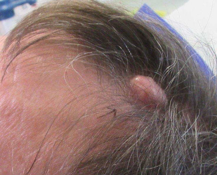Lesion Removal with Mr Tehrani