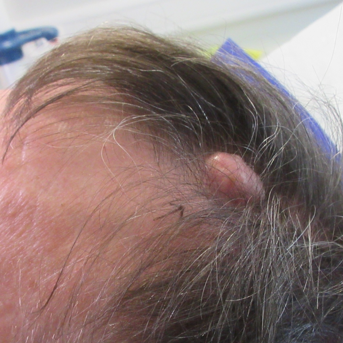 Image showcasing Cyst Removal UK | Mr Tehrani – Consultant Skin & Mohs Surgeon