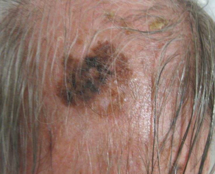 Melanoma with Mt Tehrani
