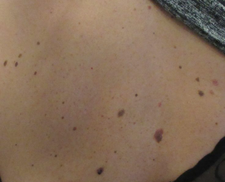 Mole Removal with Mr Tehrani