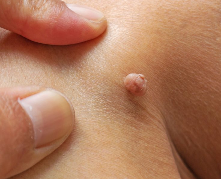 Skin Growth Removal with Mr Tehrani