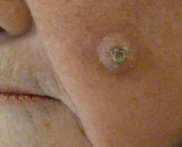 Squamous cell carcinoma surgery with Mr Tehrani 2